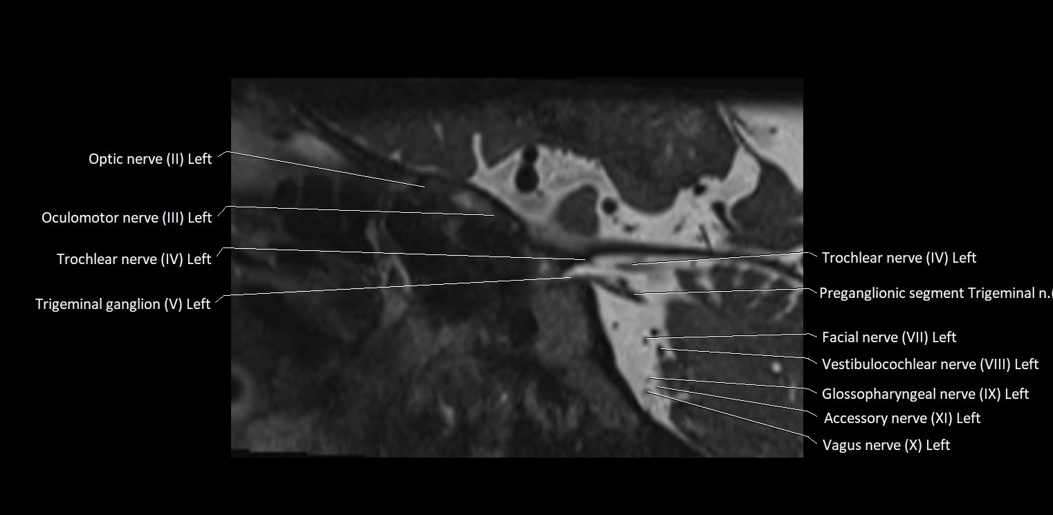 Cranial nerve sagittal anatomy MRI 3T image 21.webp